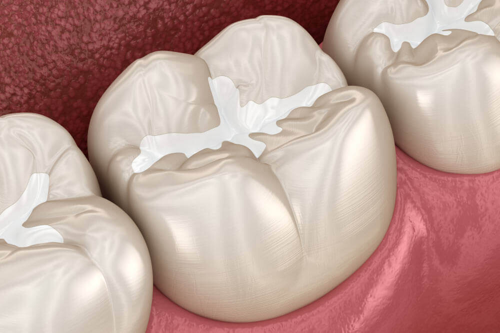 Molar Fissure dental fillings